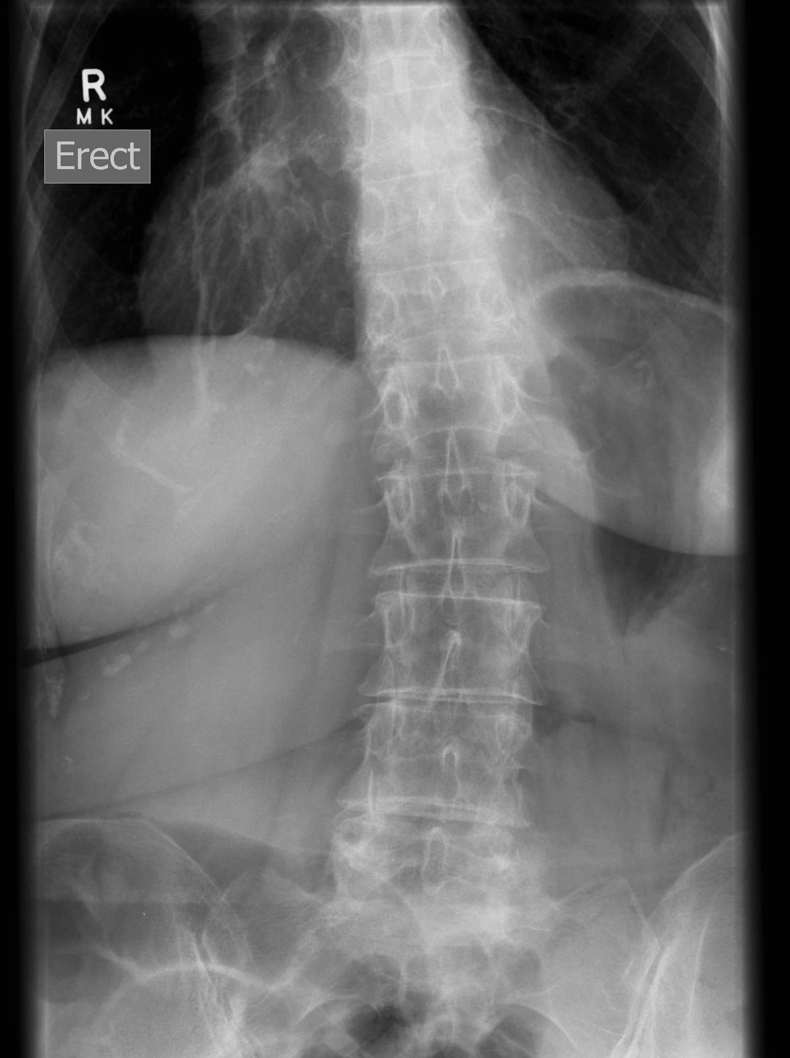 THR LLD with secondary scoliosis